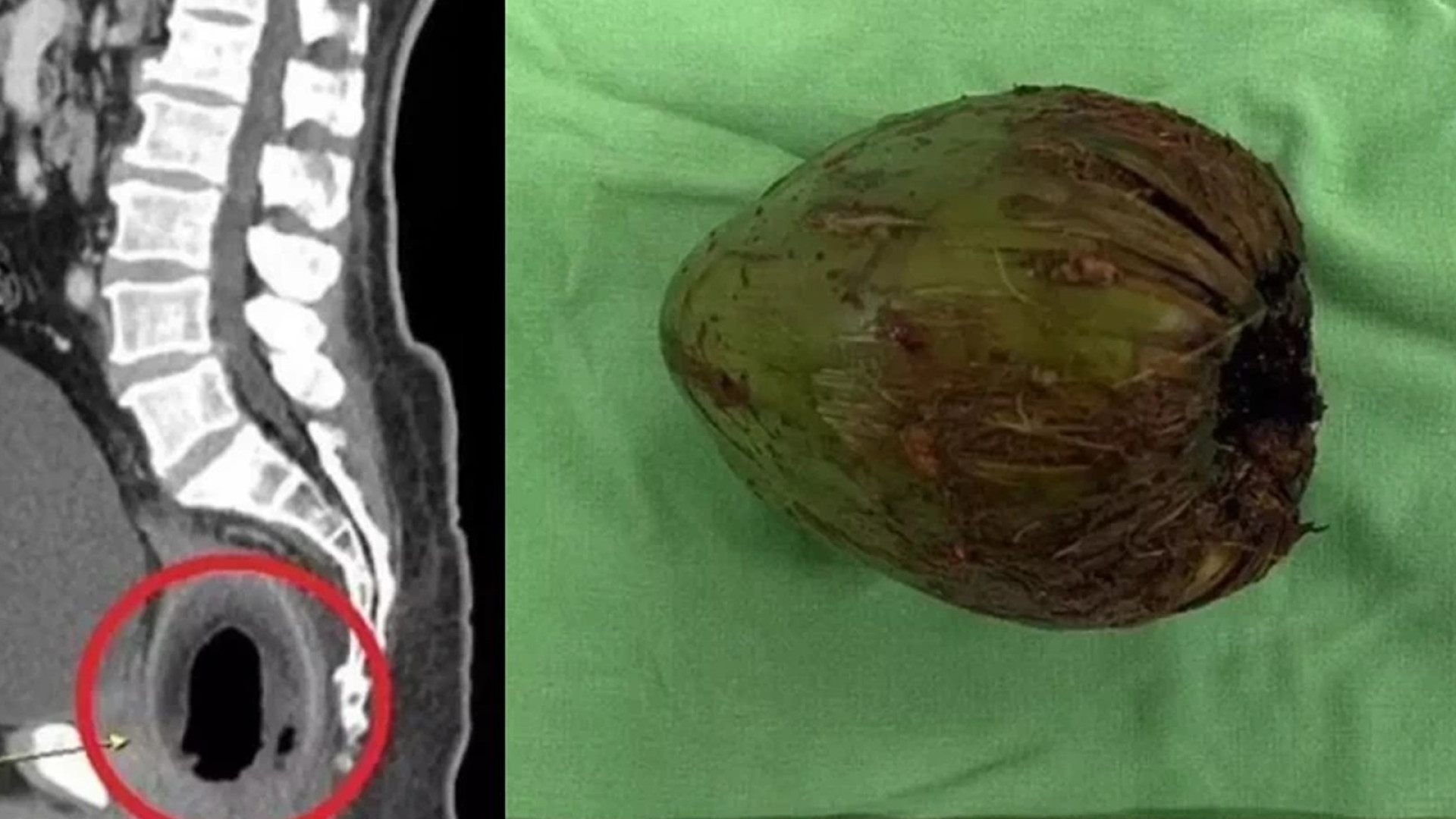 Coco no Rabo| Cirurgiões removem fruta de 9 cm de homem em Taiwan - Marreta  Urgente